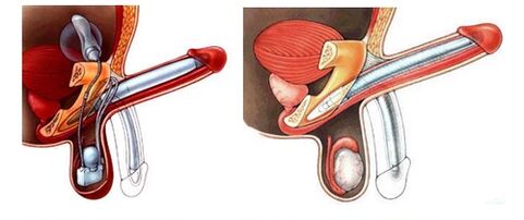 Dzimumlocekļa protēze ar piepūšamo protēzi (pa kreisi) un plastmasu (pa labi)