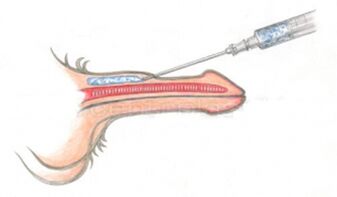 Apjomīga hialuronskābes injekcija dzimumloceklī